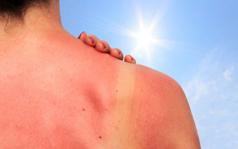Ung thư da cũng có thể xảy ra nếu không bảo vệ da khỏi tia UV